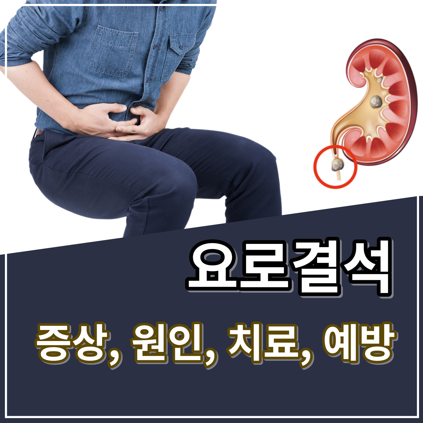 요로결석 증상, 원인, 예방방법